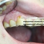 клык до маркера клык до маркера