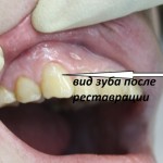 клык после лечения клык после лечения