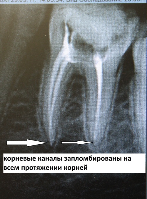 Снимок запломбированного зуба.